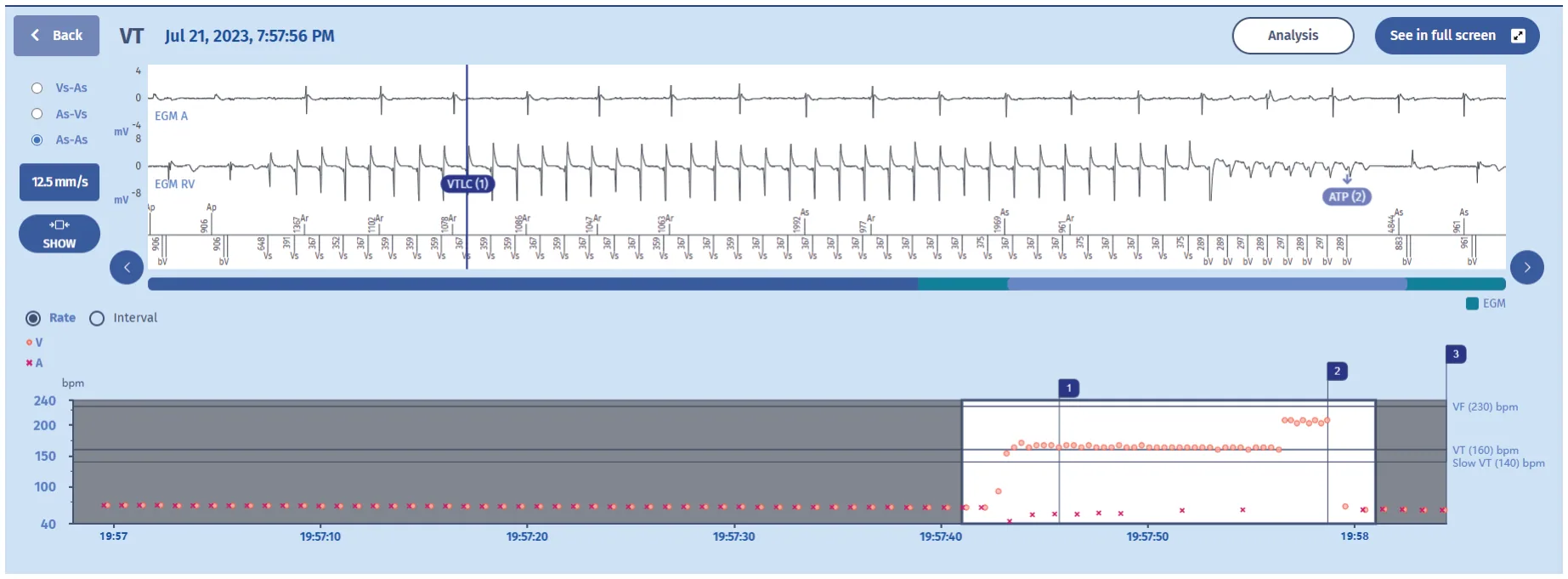 MicroPort ICD, This is one of the episodes responsible for palpitations, set to 12,5 mm/sec: — Preferred PARAD+ pathway