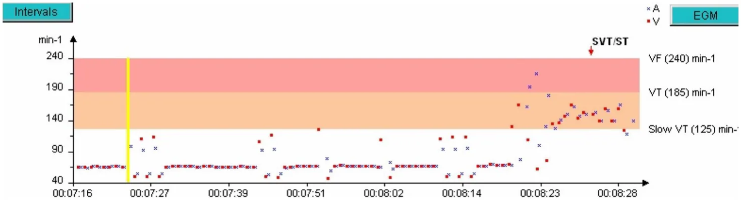 MicroPort ICD, Rate interval plot — A well classified 1:1 tachycardia