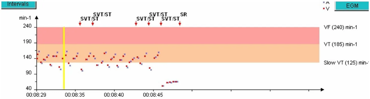 MicroPort ICD, Rate interval plot — A well classified 1:1 tachycardia