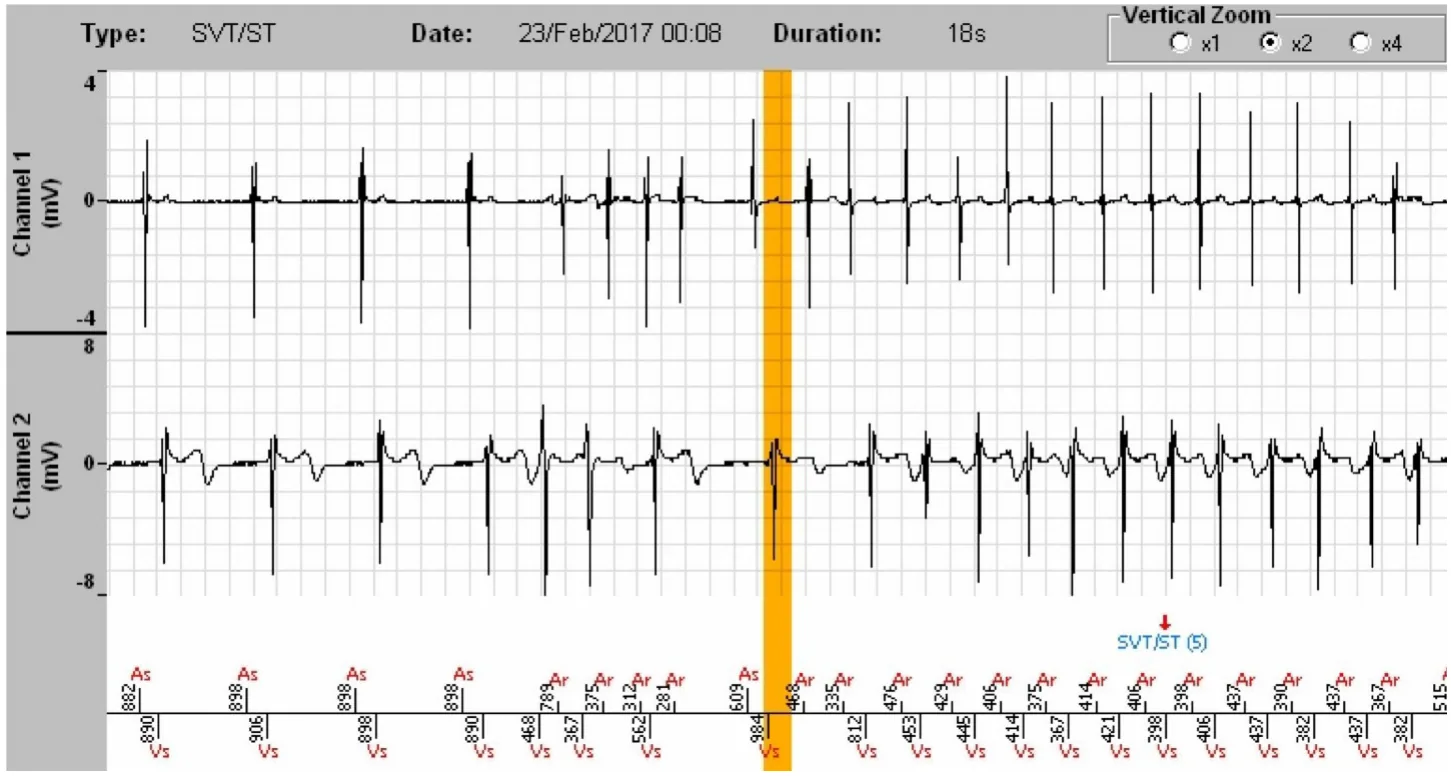 MicroPort ICD, EGM — A well classified 1:1 tachycardia