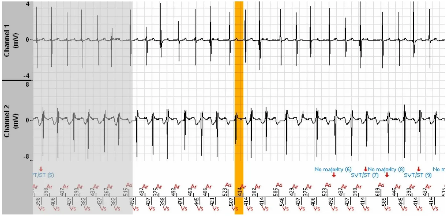 MicroPort ICD, EGM — A well classified 1:1 tachycardia