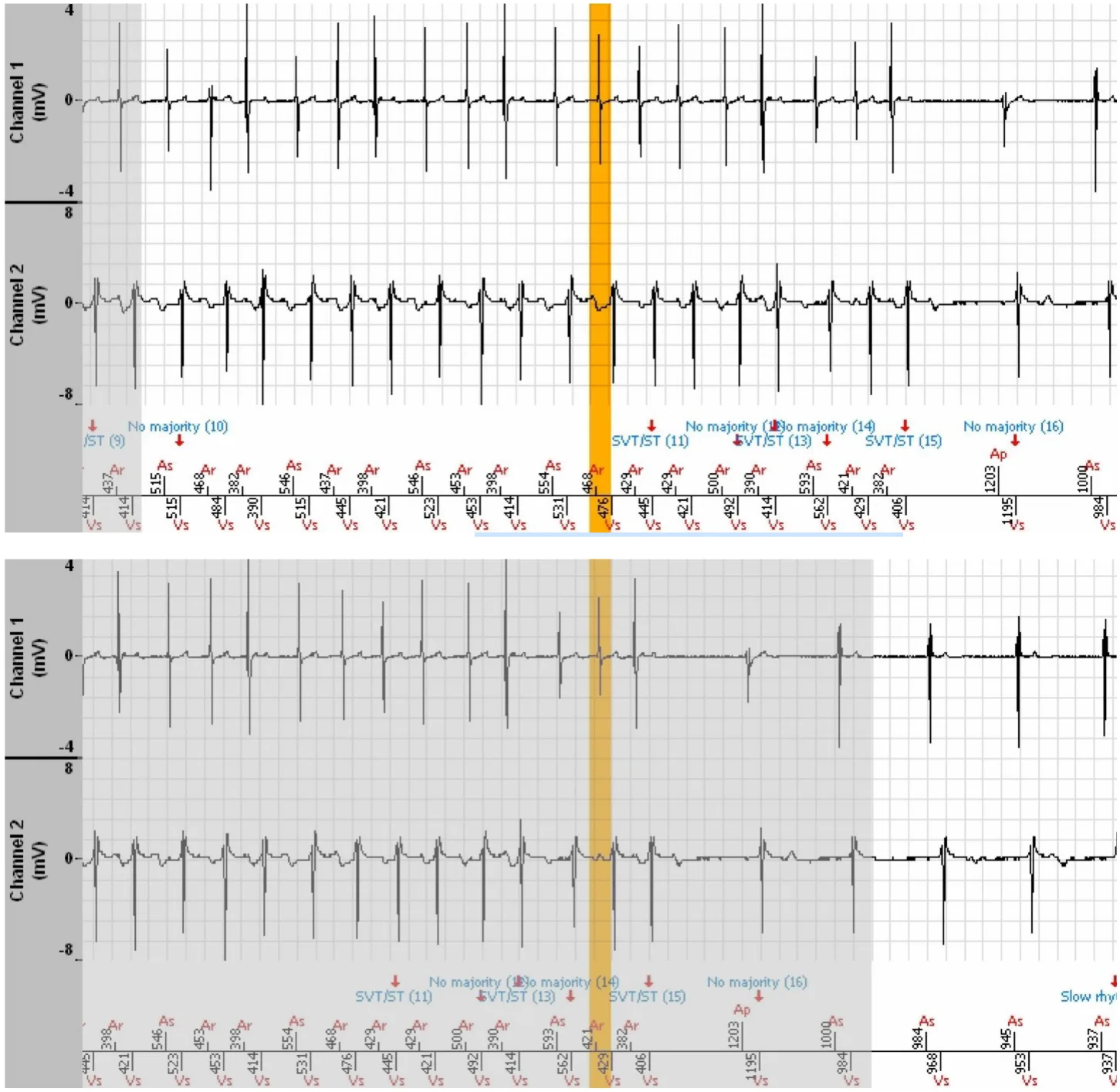 MicroPort ICD, EGM — A well classified 1:1 tachycardia
