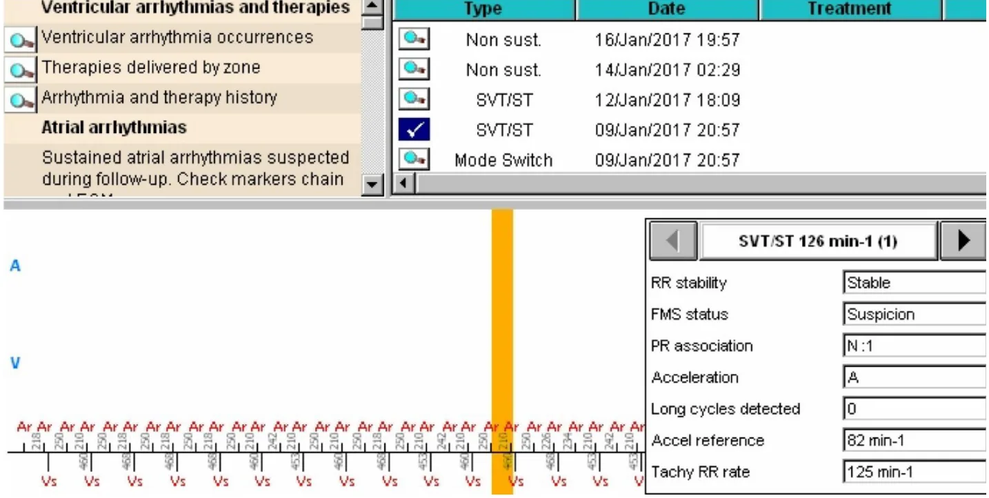 MicroPort ICD, EGM — Appropriate discrimination? Analyse everything!