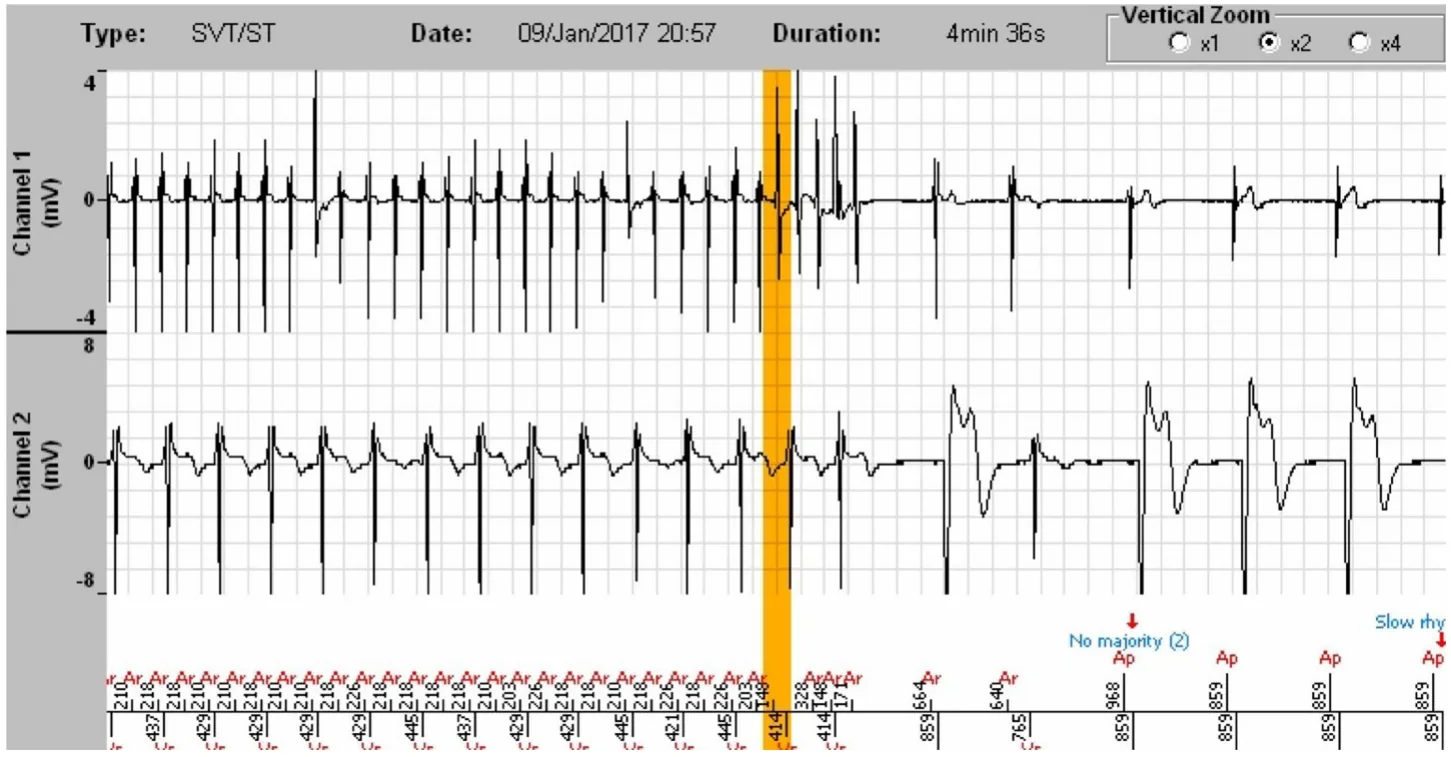 MicroPort ICD, EGM — Appropriate discrimination? Analyse everything!