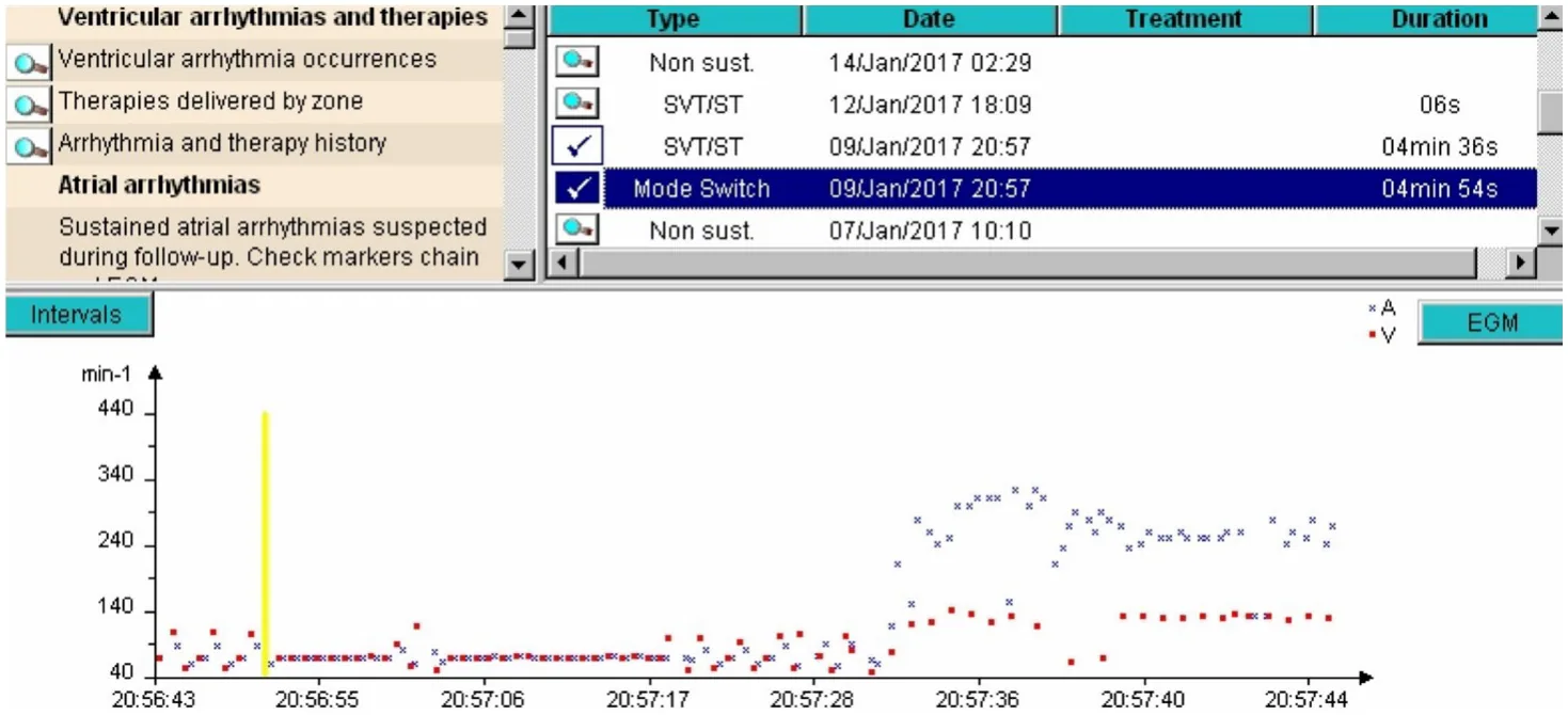 MicroPort ICD, Interpretation — Appropriate discrimination? Analyse everything!