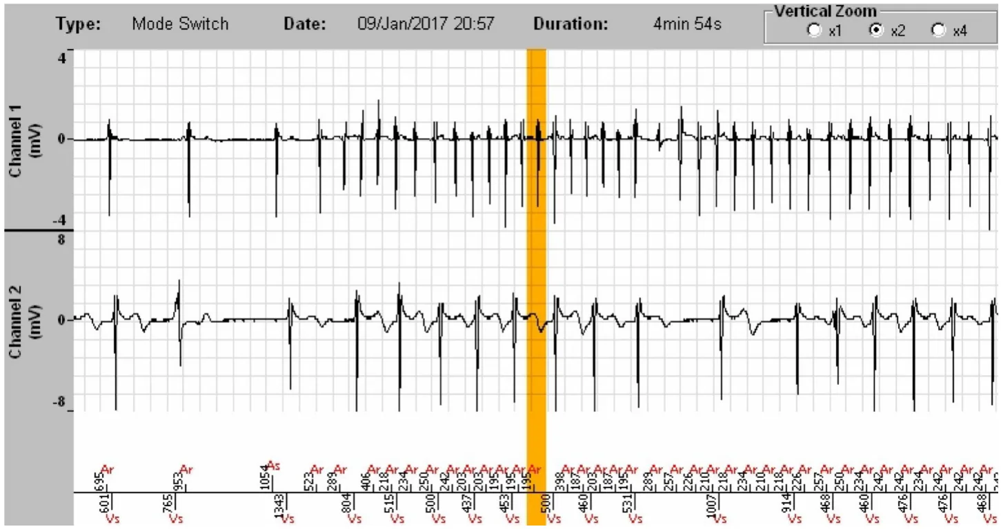MicroPort ICD, Interpretation — Appropriate discrimination? Analyse everything!
