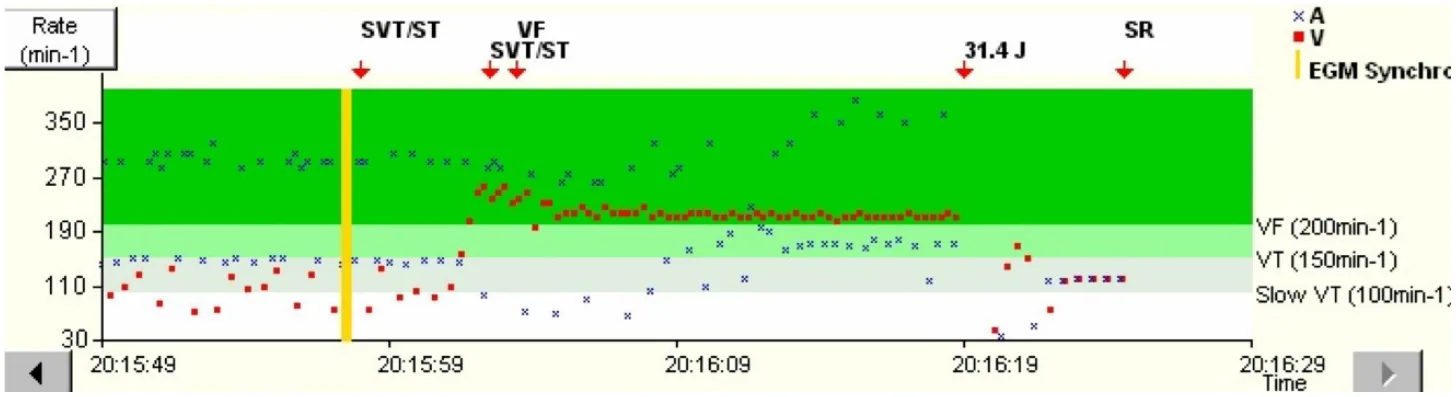 MicroPort ICD, Interval plot — Bitachycardia ?