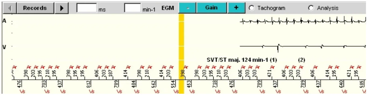 MicroPort ICD, EGM — Bitachycardia ?