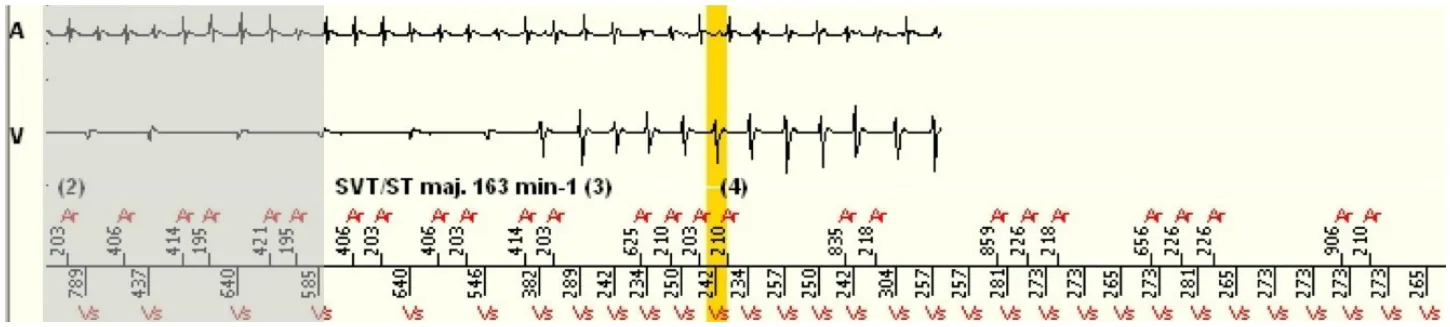 MicroPort ICD, EGM — Bitachycardia ?
