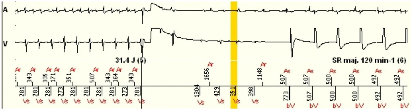 MicroPort ICD, EGM — Bitachycardia ?