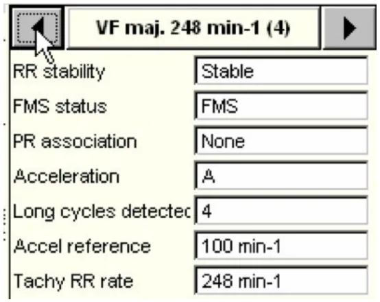 MicroPort ICD, Comments — Bitachycardia ?