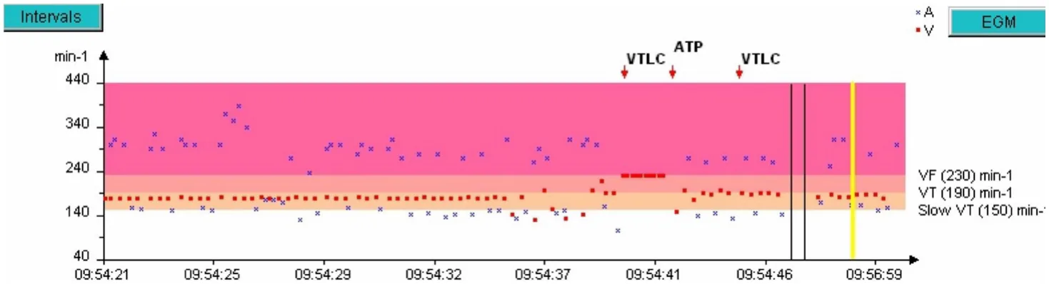 MicroPort ICD, Rate interval plot — Stabilisation of a tachycardia against a backdrop of atrial arrhythmia; a very difficult diagnosis