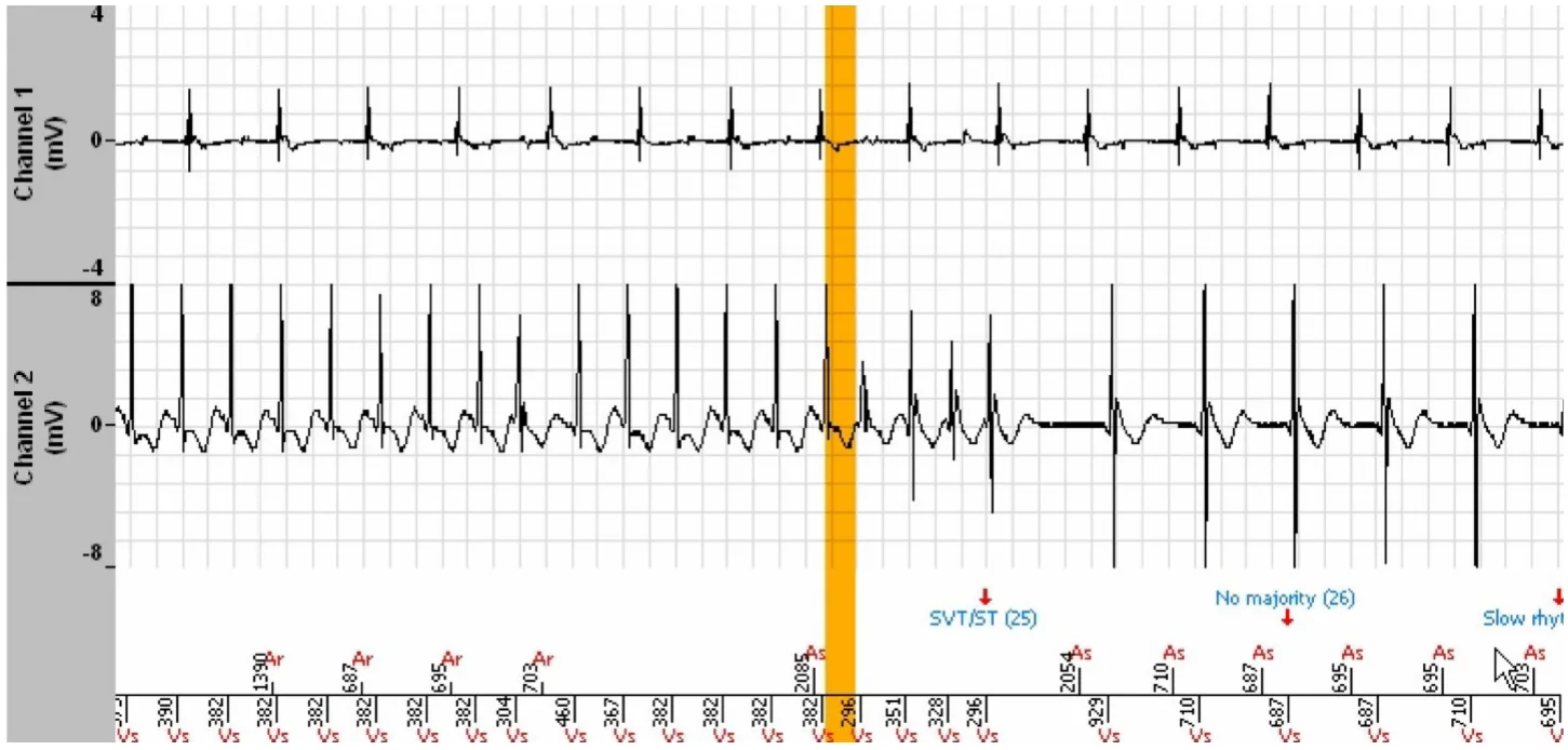 MicroPort ICD, Interpretation — Stabilisation of a tachycardia against a backdrop of atrial arrhythmia; a very difficult diagnosis