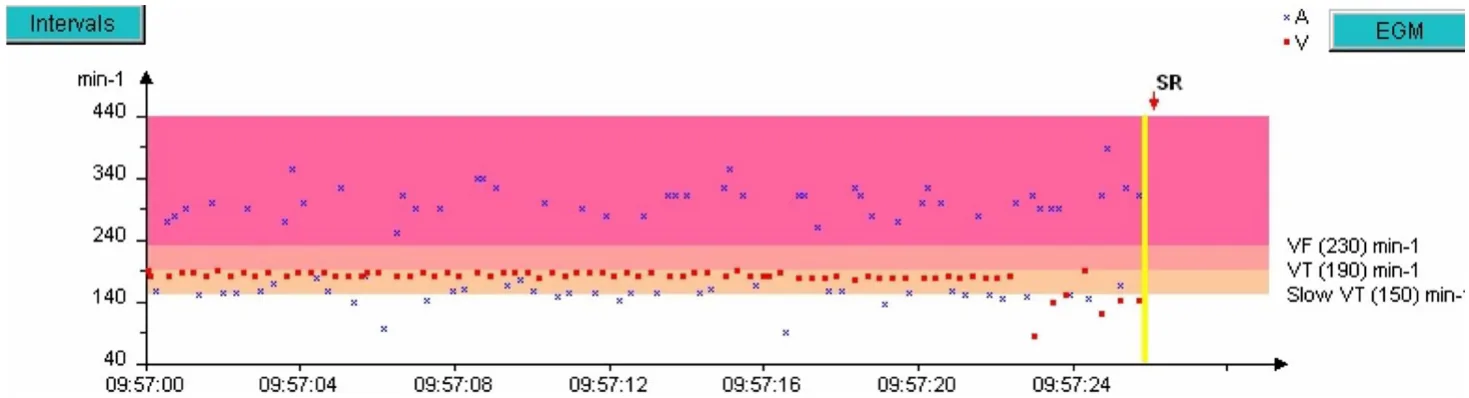 MicroPort ICD, Rate interval plot — Stabilisation of a tachycardia against a backdrop of atrial arrhythmia; a very difficult diagnosis