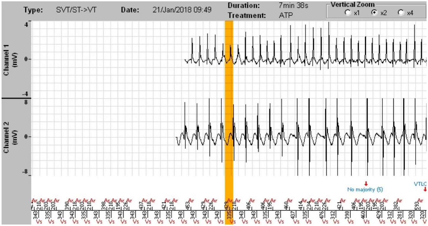 MicroPort ICD, EGM — Stabilisation of a tachycardia against a backdrop of atrial arrhythmia; a very difficult diagnosis