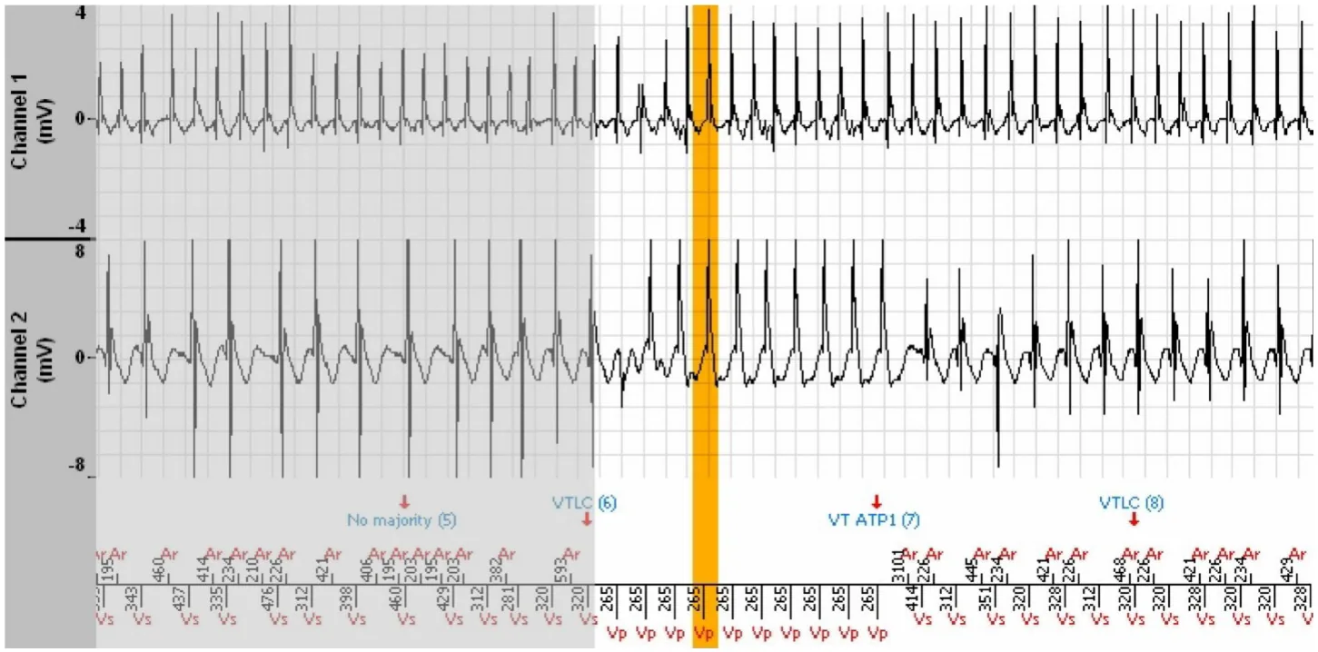 MicroPort ICD, EGM — Stabilisation of a tachycardia against a backdrop of atrial arrhythmia; a very difficult diagnosis