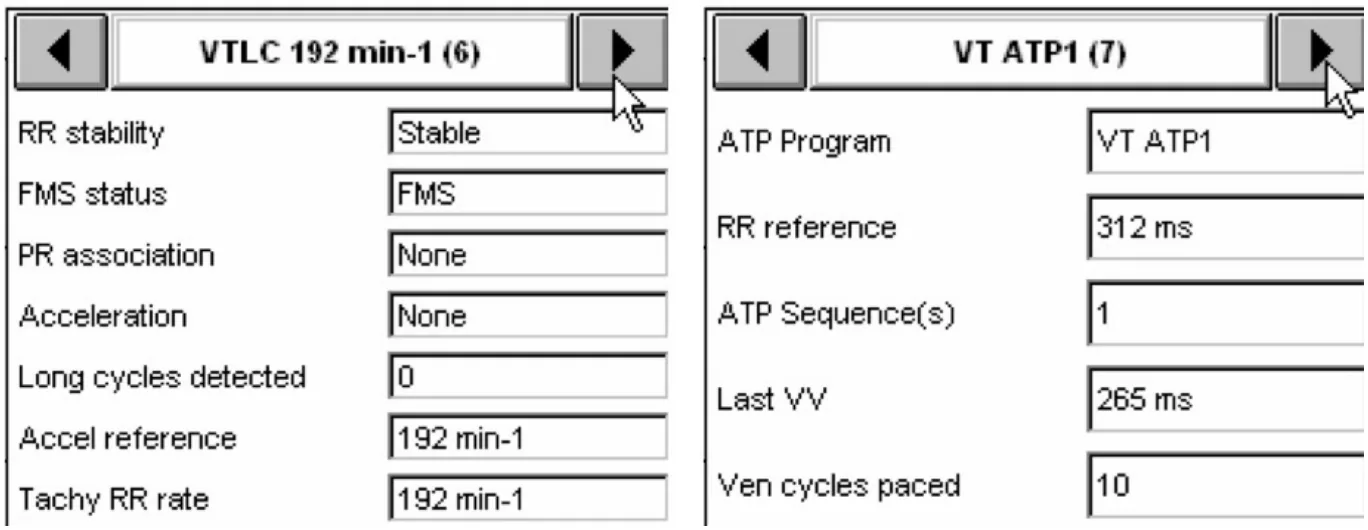 MicroPort ICD, Interpretation — Stabilisation of a tachycardia against a backdrop of atrial arrhythmia; a very difficult diagnosis