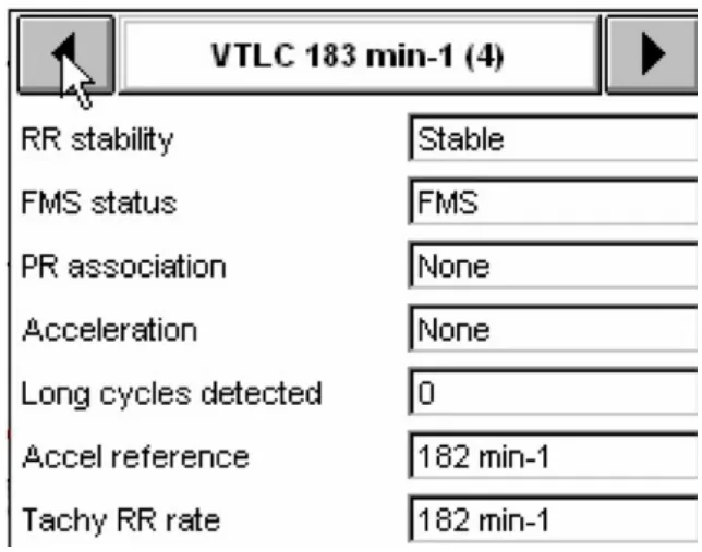 MicroPort ICD, Interpretation — Stabilisation of a tachycardia against a backdrop of atrial arrhythmia; a very difficult diagnosis