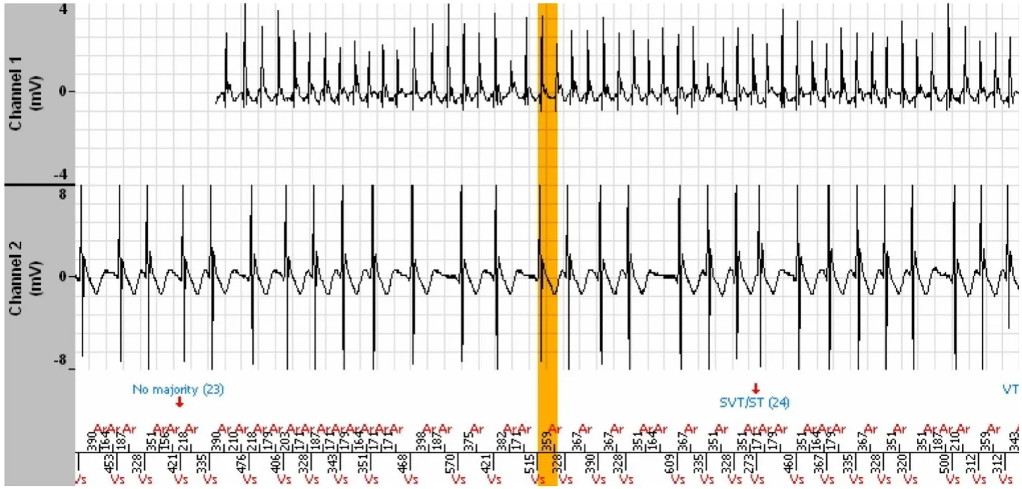 MicroPort ICD, Interpretation — Stabilisation of a tachycardia against a backdrop of atrial arrhythmia; a very difficult diagnosis