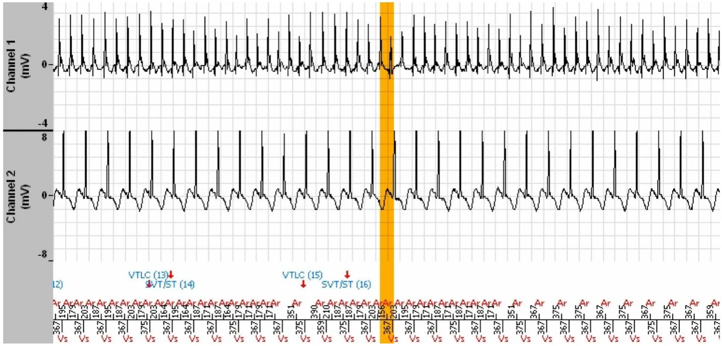 MicroPort ICD, Interpretation — Stabilisation of a tachycardia against a backdrop of atrial arrhythmia; a very difficult diagnosis
