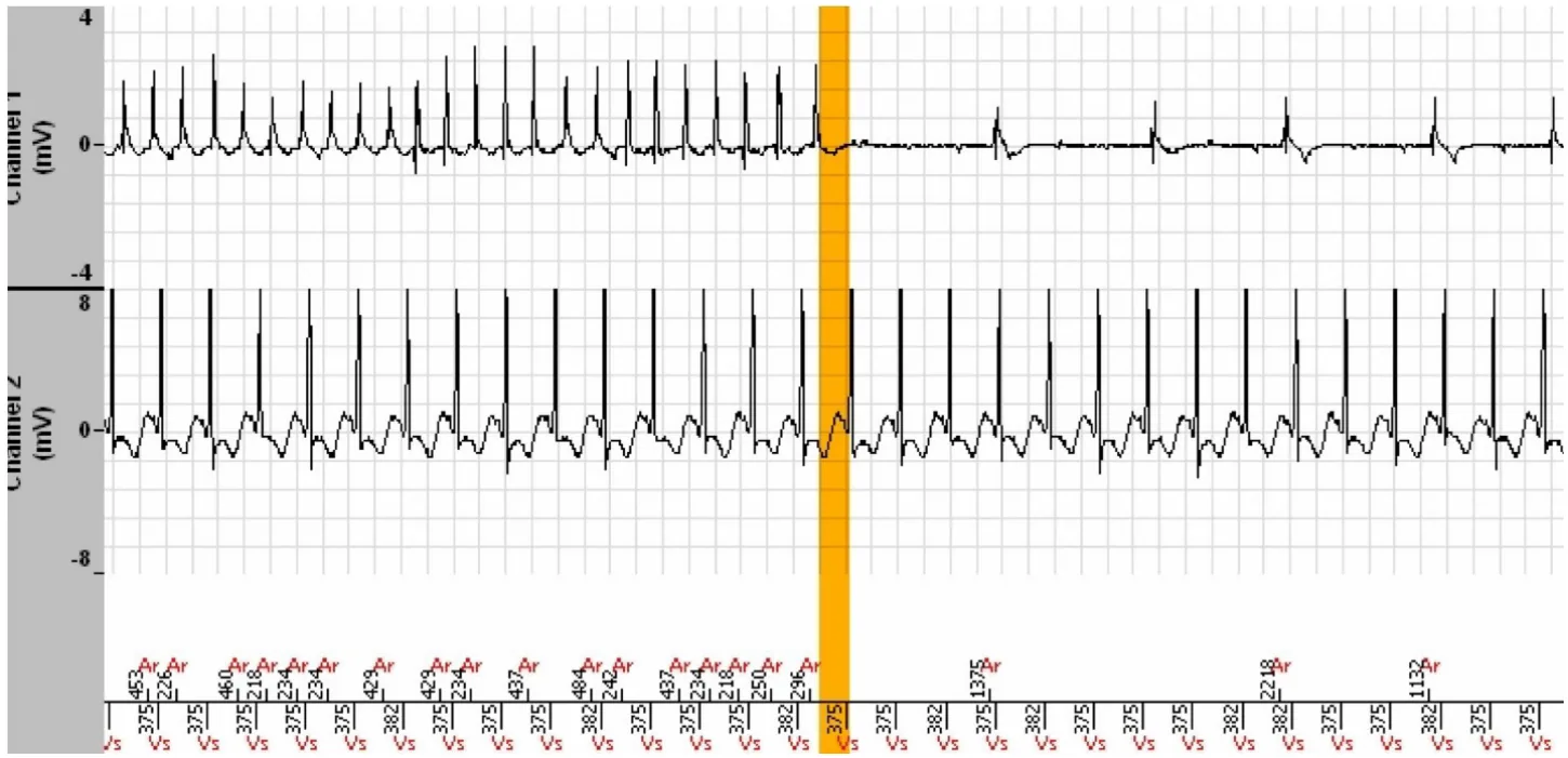 MicroPort ICD, Interpretation — Stabilisation of a tachycardia against a backdrop of atrial arrhythmia; a very difficult diagnosis