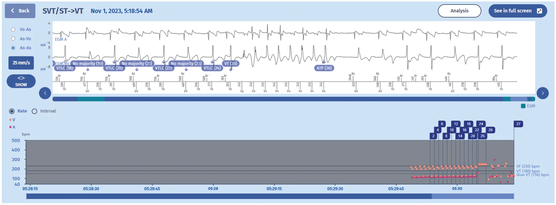 MicroPort ICD, EGM — T-wave oversensing