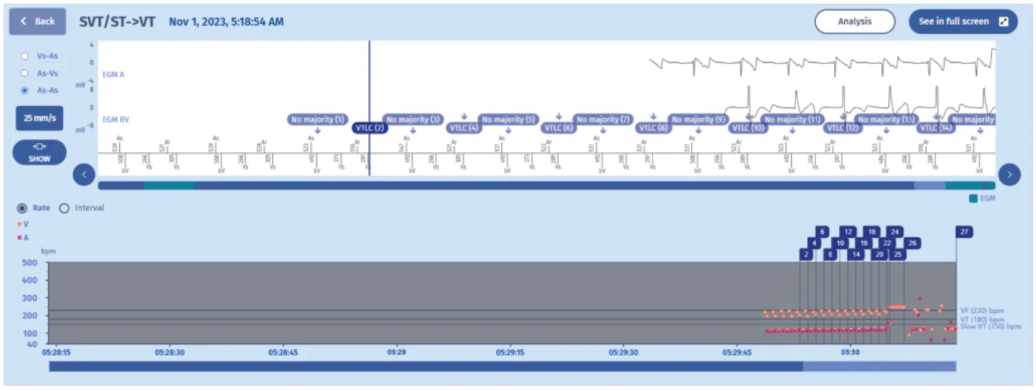 MicroPort ICD, Which of the following answers is correct? — T-wave oversensing