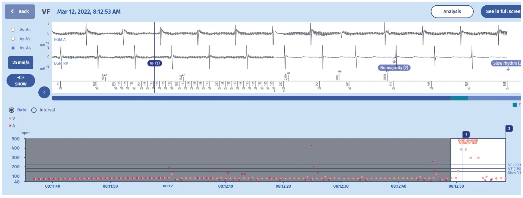 MicroPort ICD, EGM — Aborted charge