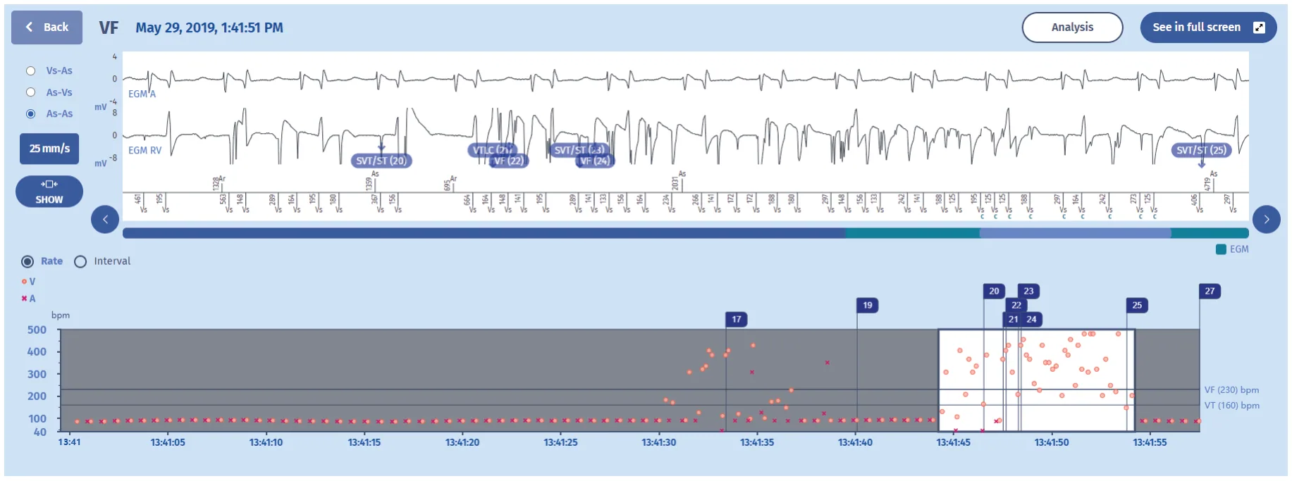 MicroPort ICD, EGM 2 (older episode) — Lead dysfunction