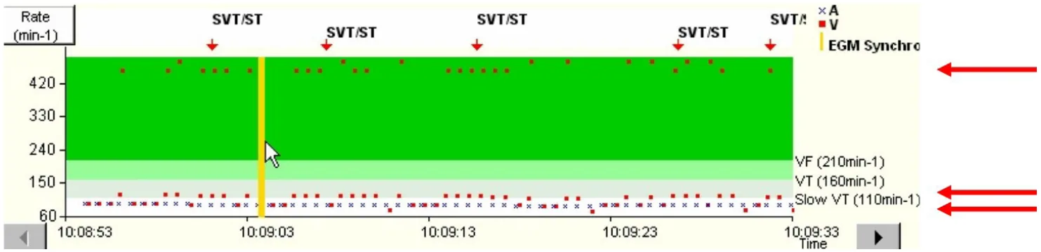 MicroPort ICD, Case 4 — Oversensing of the P waves