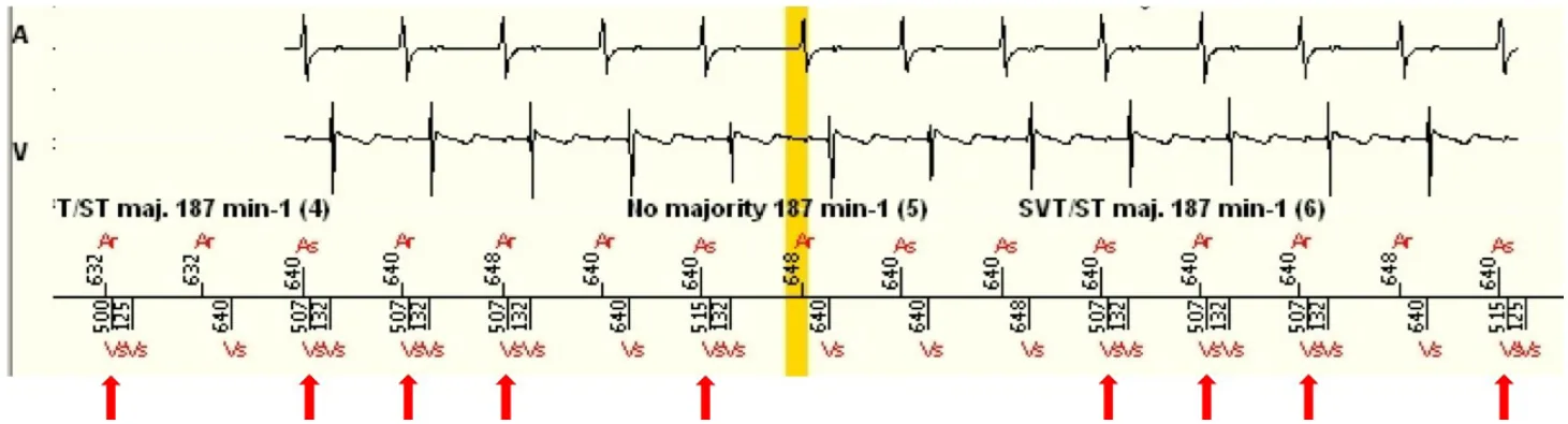 MicroPort ICD, Case 4 — Oversensing of the P waves