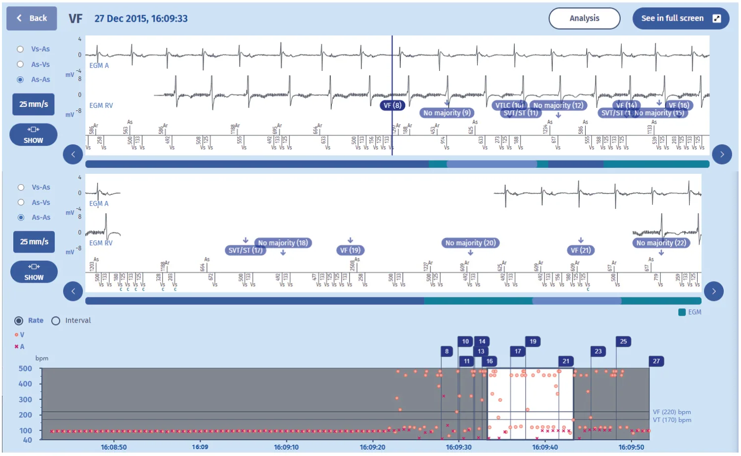 MicroPort ICD, Programming — Extracardiac oversensing