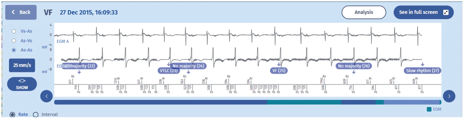MicroPort ICD, Programming — Extracardiac oversensing