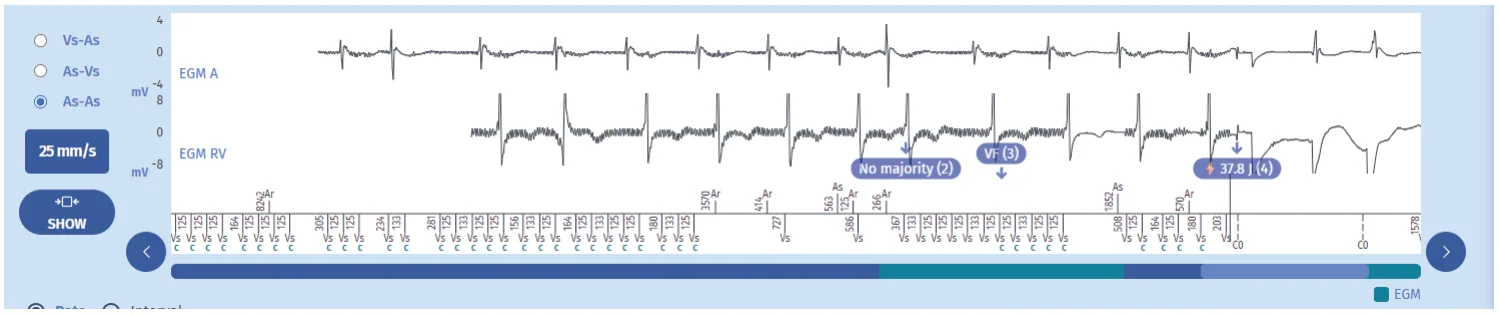 MicroPort ICD, Programming — Extracardiac oversensing