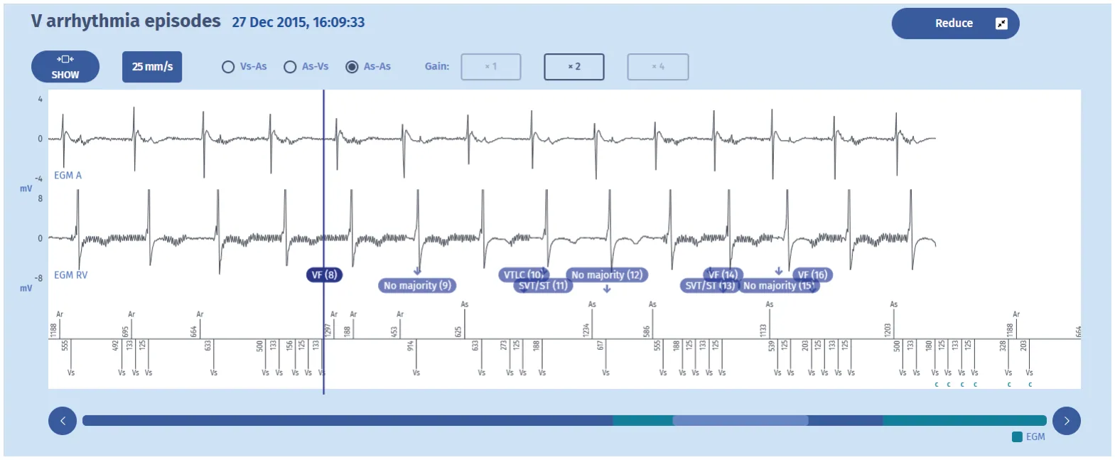 MicroPort ICD, What is the most probable diagnosis ? — Extracardiac oversensing