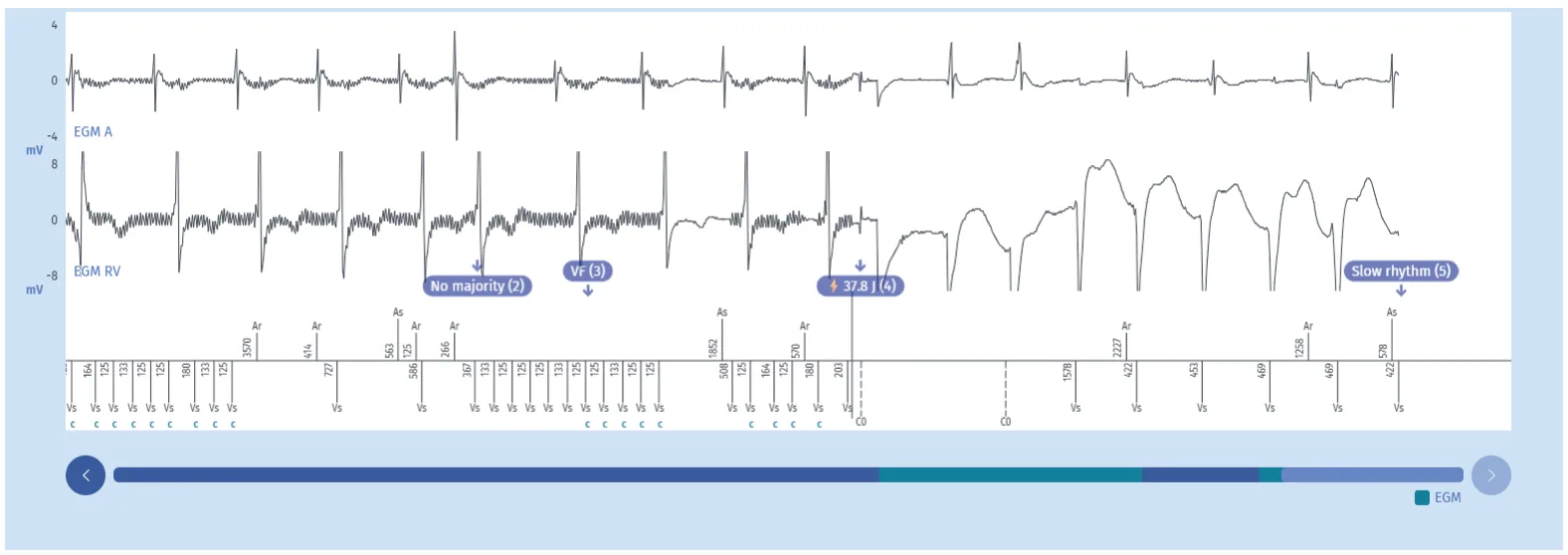 MicroPort ICD, Interpretation — Extracardiac oversensing