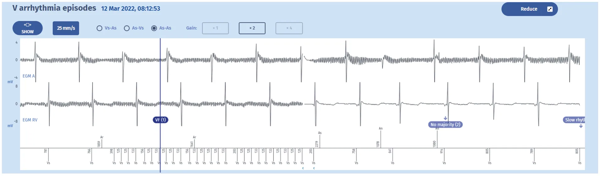 MicroPort ICD, Case 6 — Oversensing of signals generated by the 50 Hz line current
