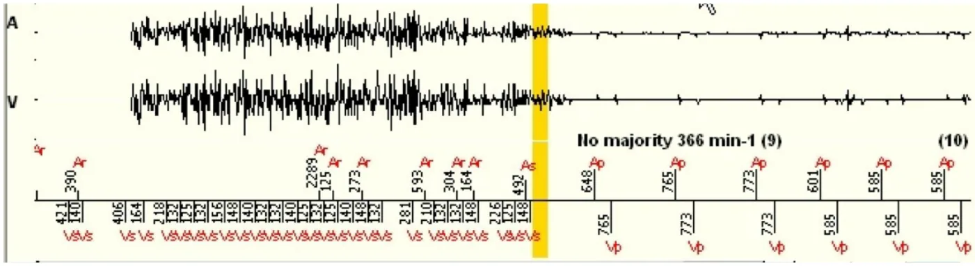 MicroPort ICD, Case 7 — Oversensing from the use of a electrocautery knife