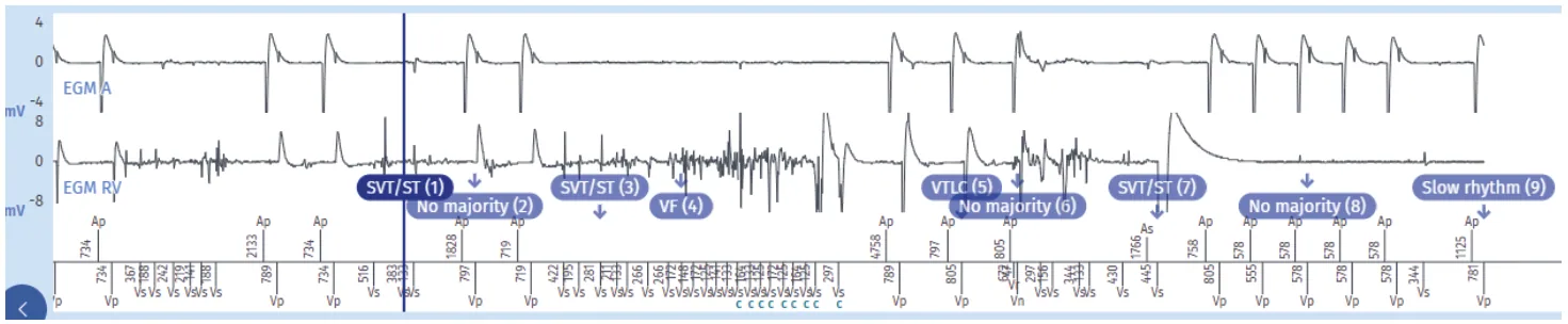 MicroPort ICD, EGM saved into the memory of the device as «VF» — An emergency!