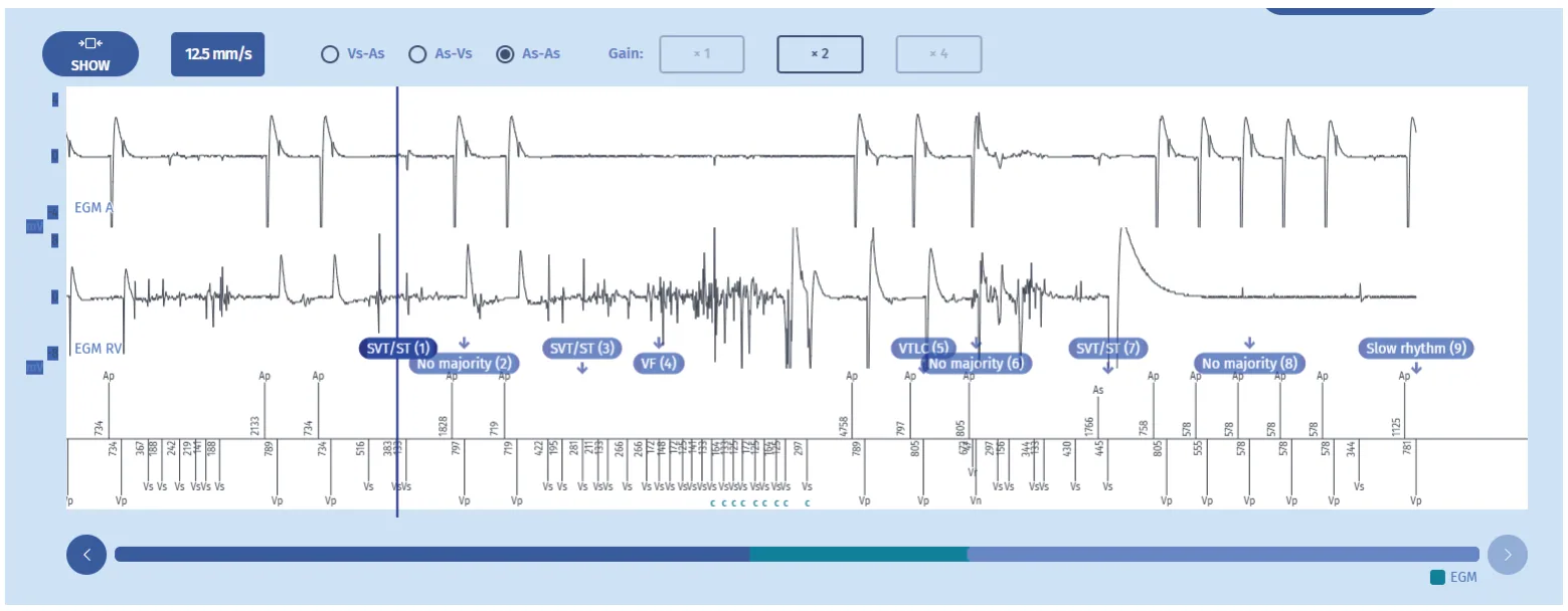 MicroPort ICD, Episode recorded during the emergency follow-up, after manipulation of the defibrillator case through the skin — An emergency!