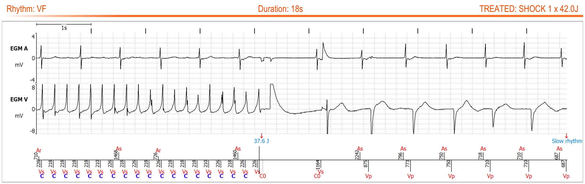 MicroPort ICD, Transmission 3 — Shocks delivered