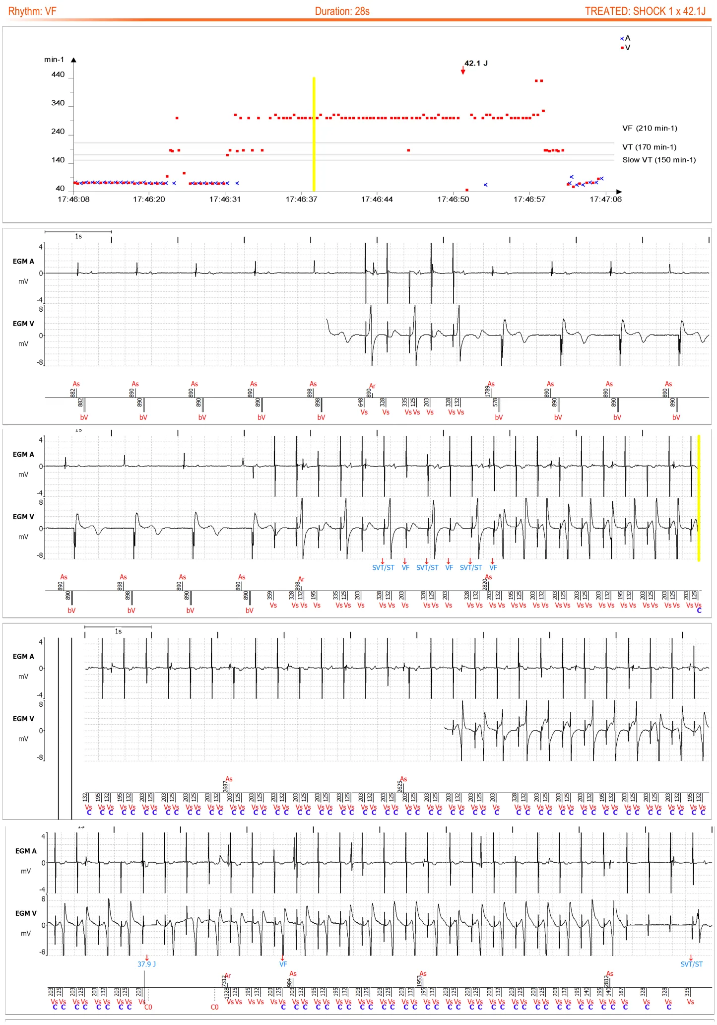 MicroPort ICD, You receive the following transmission: — Shock delivered