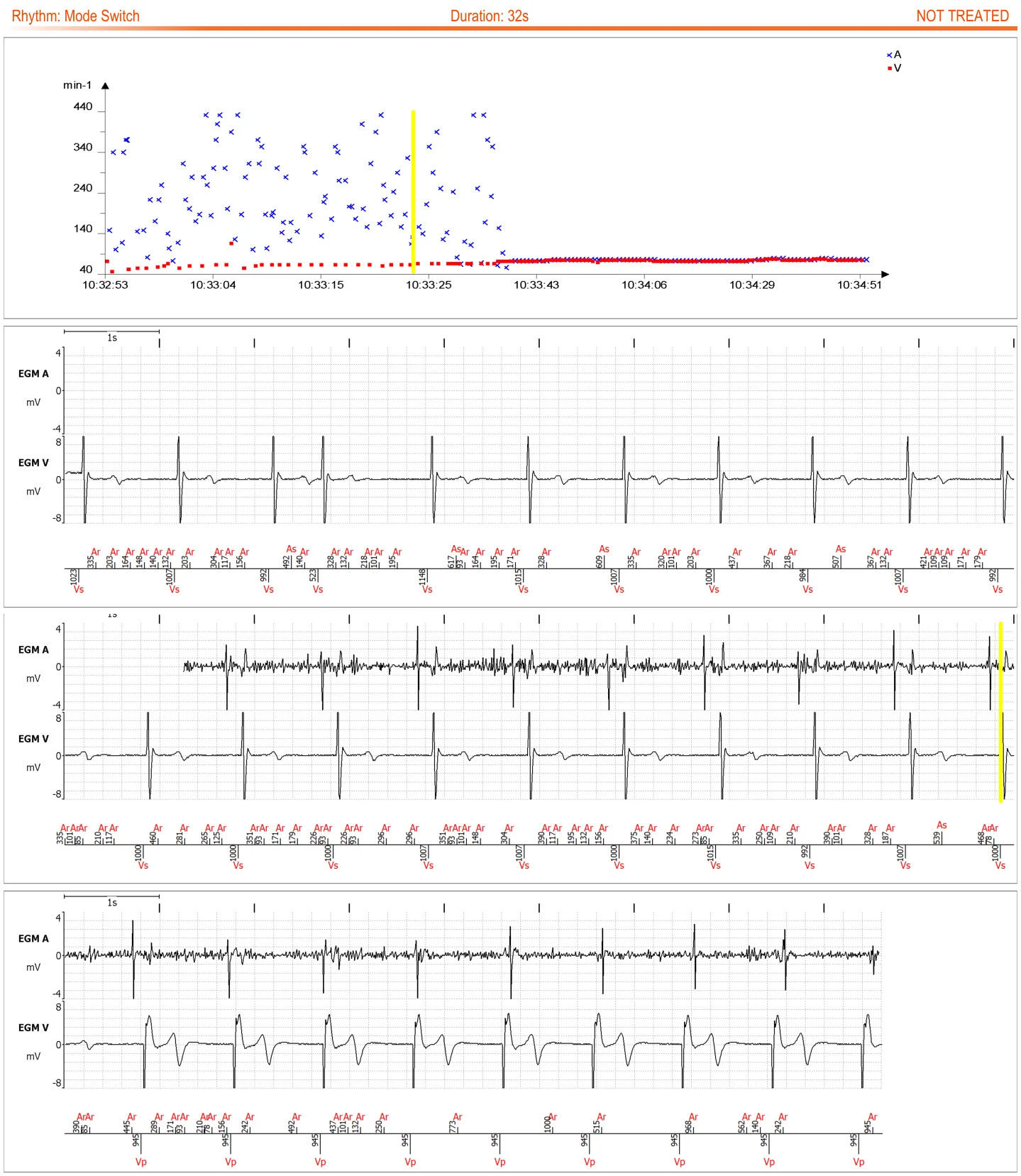 MicroPort ICD, You receive the following transmission — Atrial lead impedance