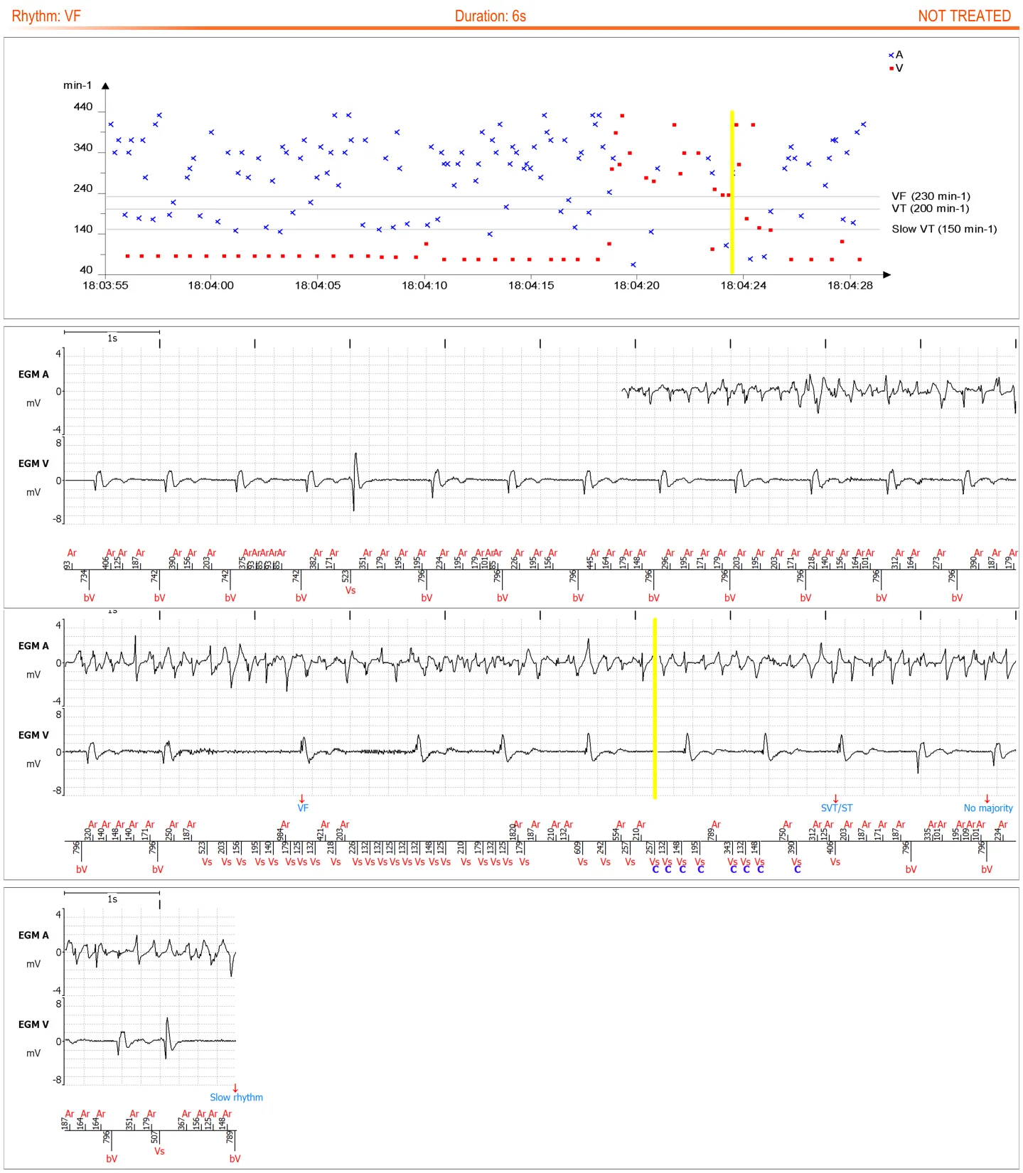 MicroPort ICD, You receive the following transmission: — Ventricular oversensing suspected