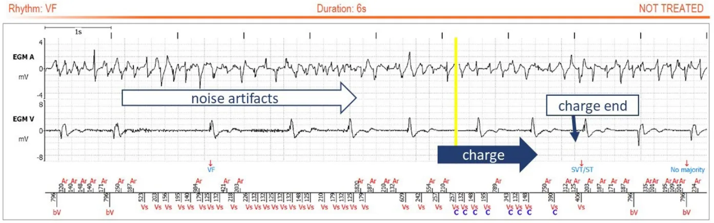 MicroPort ICD, Explications — Ventricular oversensing suspected