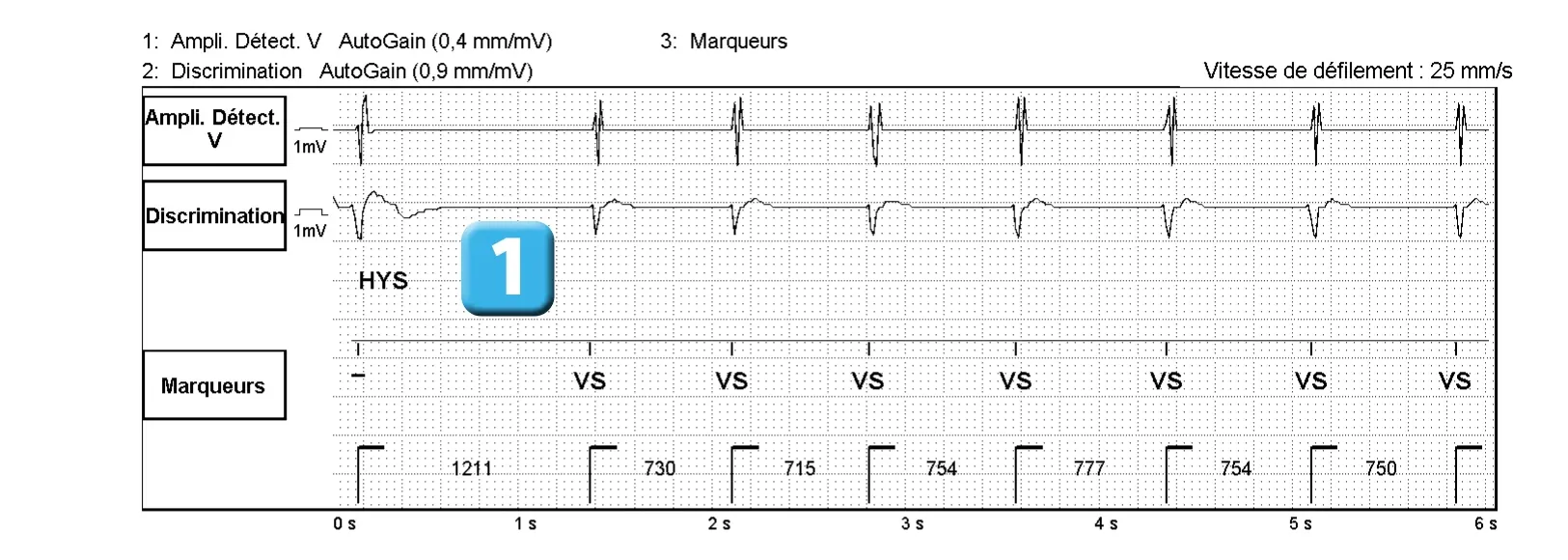 Électrogramme Abbott ICD, segment 1 sur 4 — Classification des cycles, compteurs de tachycardie et évolution des recommandations
