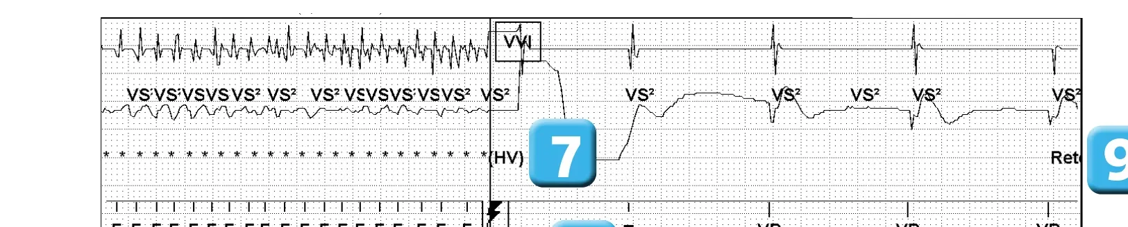Électrogramme Abbott ICD, segment 4 sur 4 — Classification des cycles, compteurs de tachycardie et évolution des recommandations