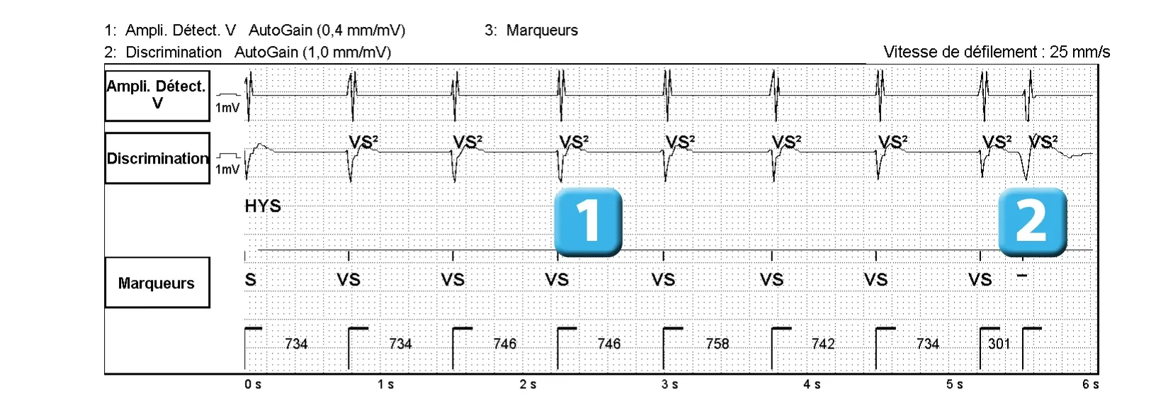 Électrogramme Abbott ICD, segment 1 sur 2 — Classification des cycles, compteurs de tachycardie et évolution des recommandations