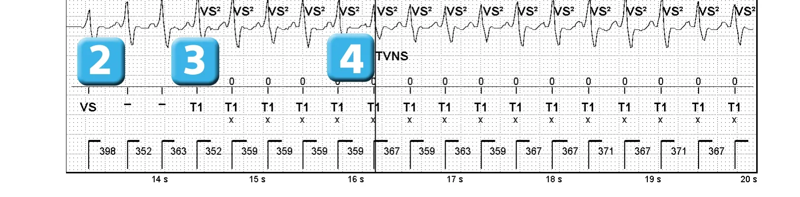 Électrogramme Abbott ICD, segment 2 sur 3 — Nouvelles recommandations et tachycardie non soutenue