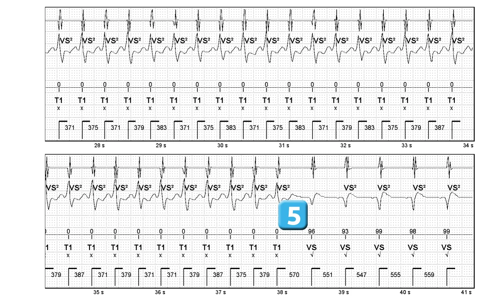Électrogramme Abbott ICD, segment 3 sur 3 — Nouvelles recommandations et tachycardie non soutenue